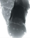 Figure 4. Oblique angle X-ray image of  a lead-free leadless ceramic chip carrier (LCCC) joint, soldered to a board, showing a fatigue crack following many repeated thermal cycles